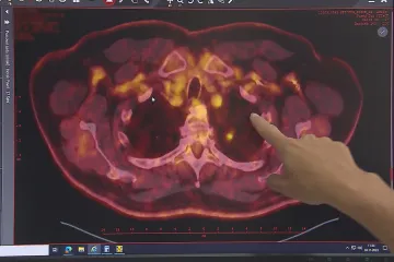 Účast na screeningu plic je pod očekáváním. Pomáhá přitom včas odhalit nádor