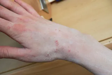 Svrab se šíří nejvíc v Moravskoslezském kraji