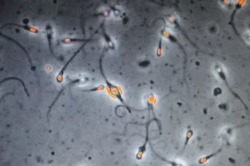 Dárce spermatu s genem způsobujícím rakovinu zplodil 200 dětí. Většině hrozí nádory