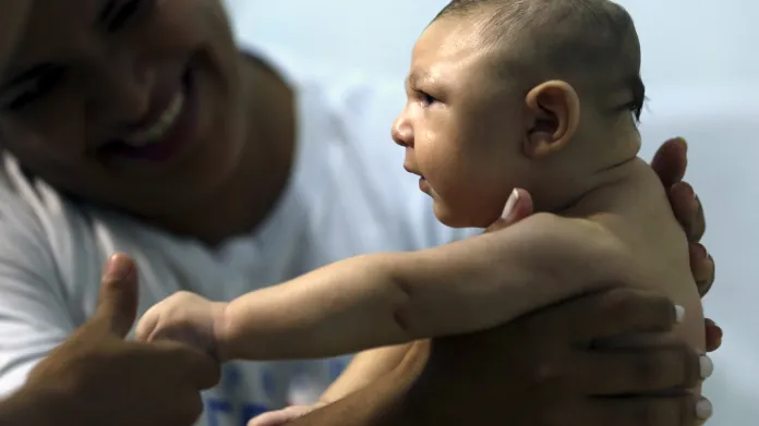 Brazilské dítě postižené mikrocefalií