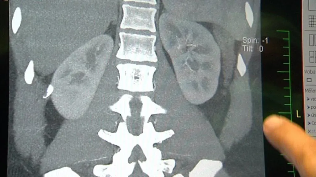 Transplantovaná ledvina na rentgenovém snímku