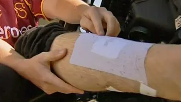 James Grant ukazuje zranění po žraločím útoku