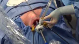 Operace štítné žlázy přes ústa