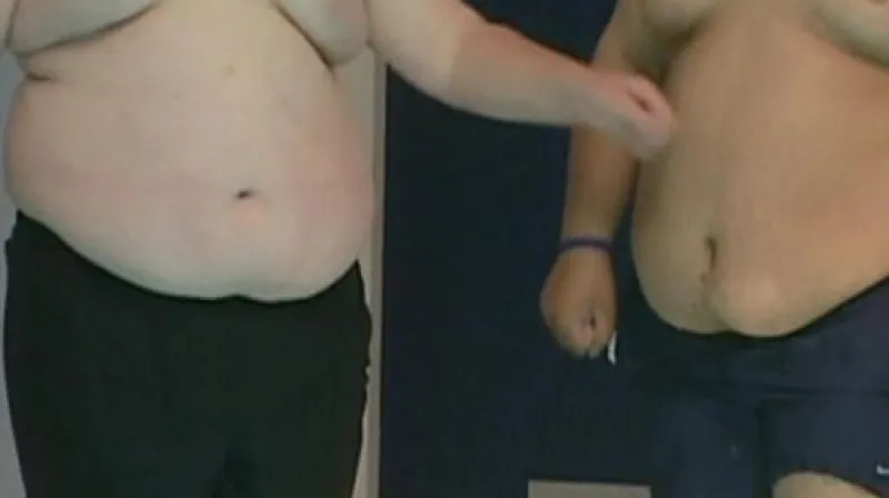 Rozhovor s Petrem Suchardou z České obezitologické společnosti