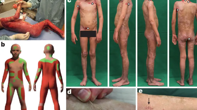 Ilustrace pokroku léčby