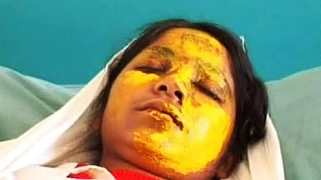 Afghánská dívka napadená kyselinou