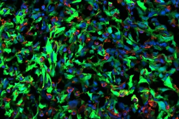 Vědci popsali, proč rakovina prsu metastazuje do mozku. Otevřeli cestu k léčbě