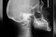 V Ostravě mají rentgen s rameny ve tvaru O. Zkracuje operaci i pobyt v nemocnici