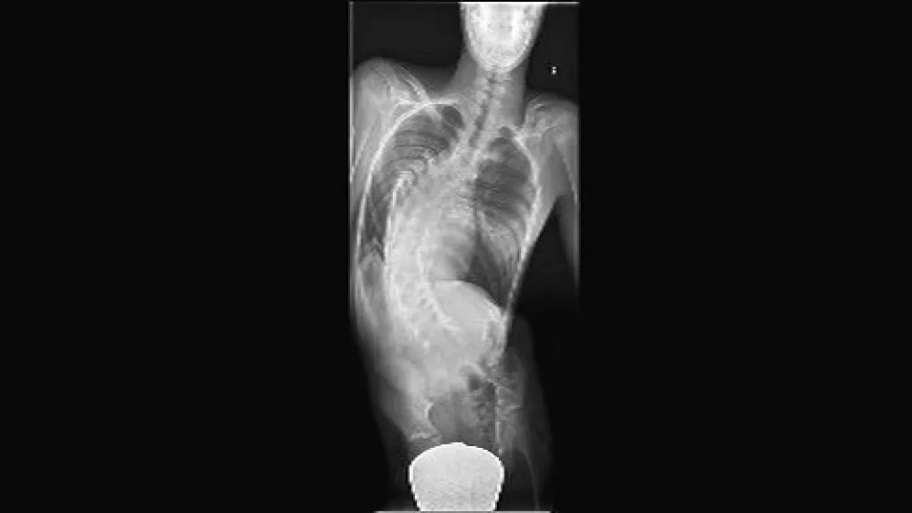 Deformovaná páteř