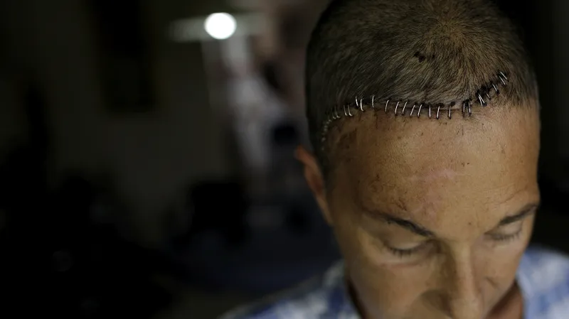 Yolyter Rodriguez (56 let), matka tří dětí, utrpěla při protestech v ulicích Caracasu frakturu lebky a poškození mozku po zasažení slzným granátem. „K demonstracím mě donutil hlad. Díky tomu jsem teď zraněná. Naše protesty ale nesmíme vzdávat!“