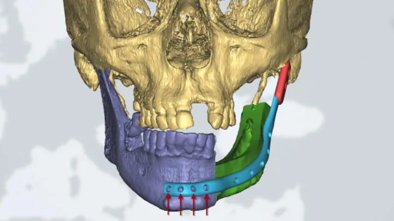 Model cílového stavu – zeleně implantovaná část čelisti, modře titanová spojka vyrobená pacientovi na míru