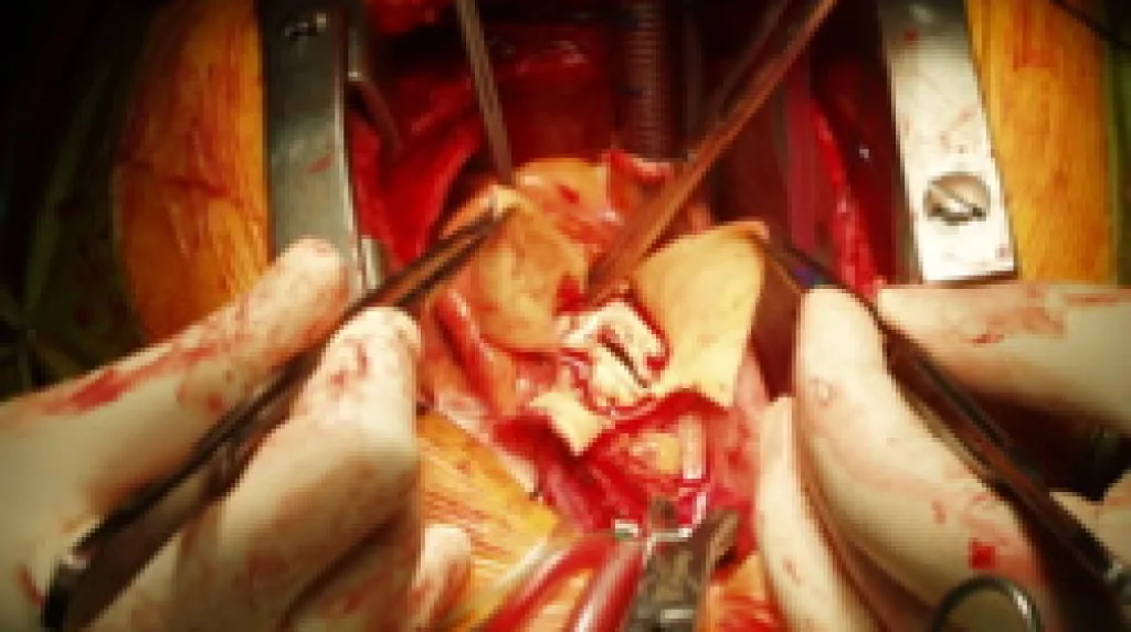 Operace srdeční chlopně
