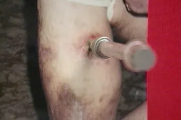 30 let zpět: Stát zaspal v prevenci proti užívání drog