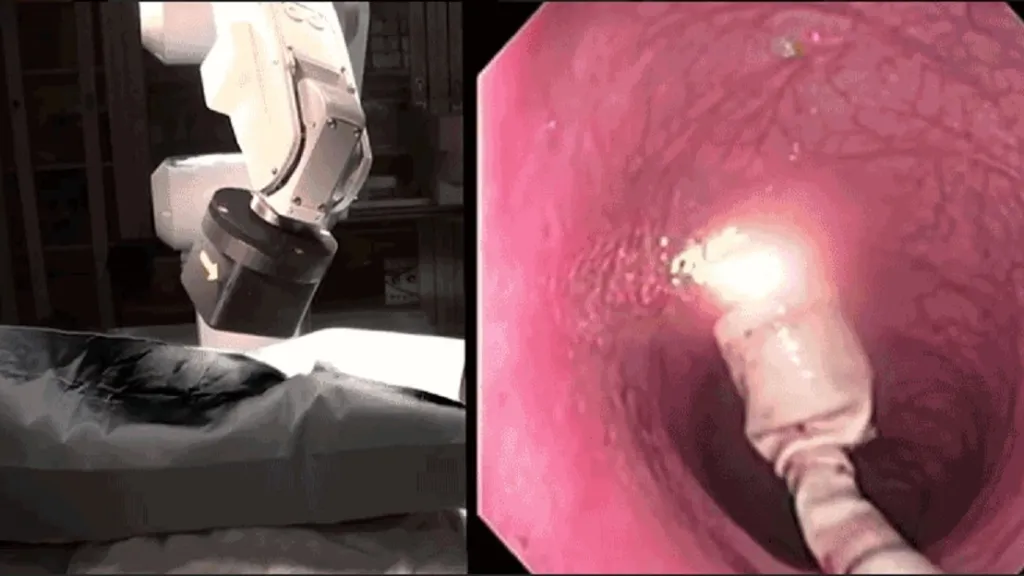 Robotická kolonoskopie