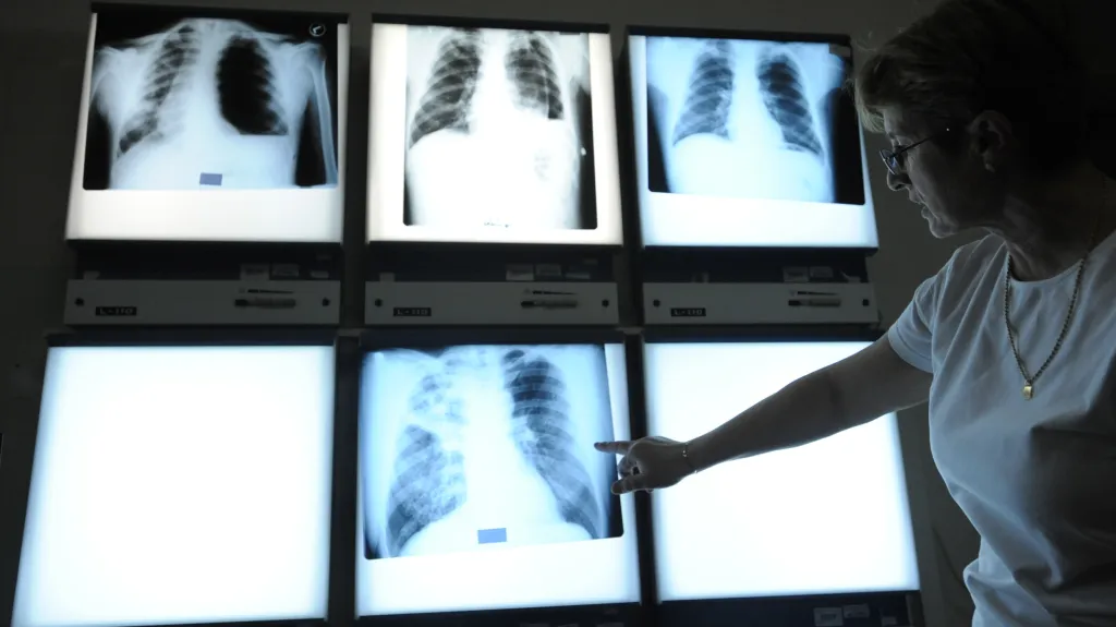 Rentgenové snímky plic s tuberkulózou