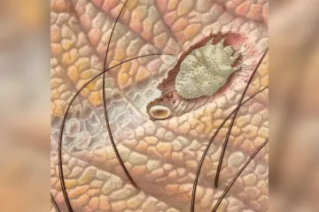 Svrab se v Praze šíří rychleji než v předchozích letech