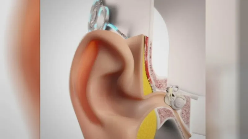 Model kochleárního implantátu