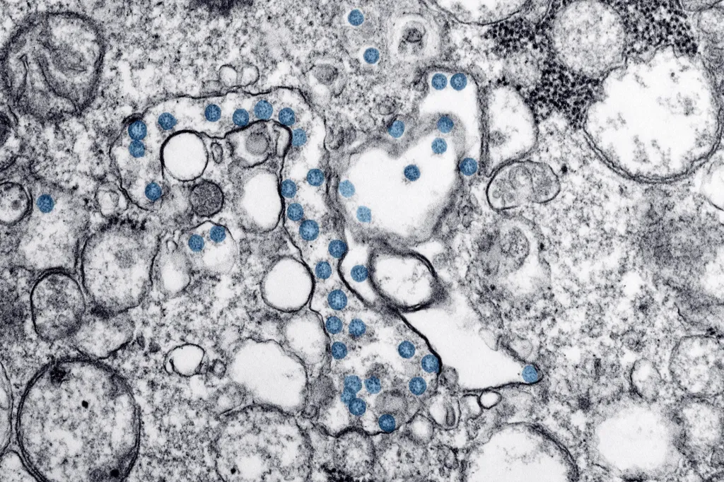 Elektronický mikroskop odhalil COVID-19 u prvního pacienta v USA. Tato fotografie je ze vzorku tkáně tohoto pacienta z Atlanty v laboratoři Centers for Disease Control