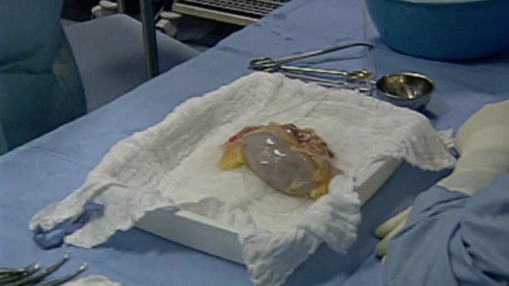 Transplantace ledviny