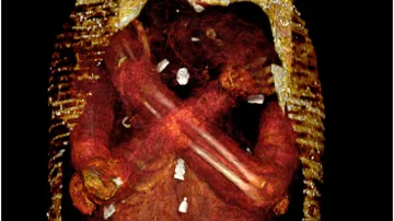 CT sken mumie „zlatého chlapce“