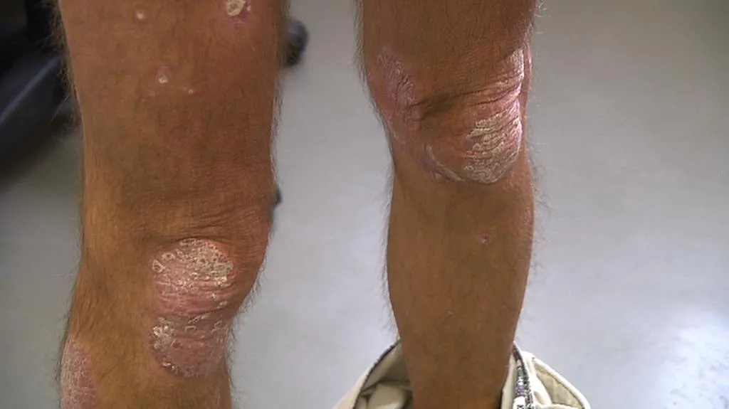 Lupénka (latinsky: psoriasis vulgaris)