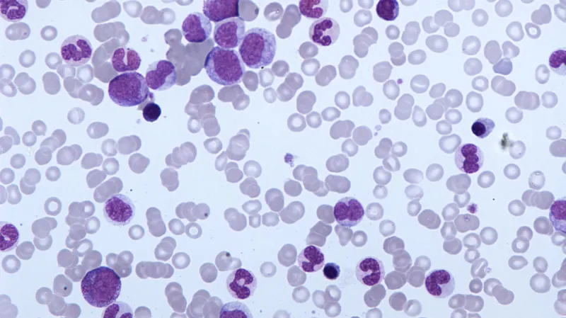 Leukemie