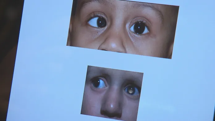Nádor oka retinoblastom