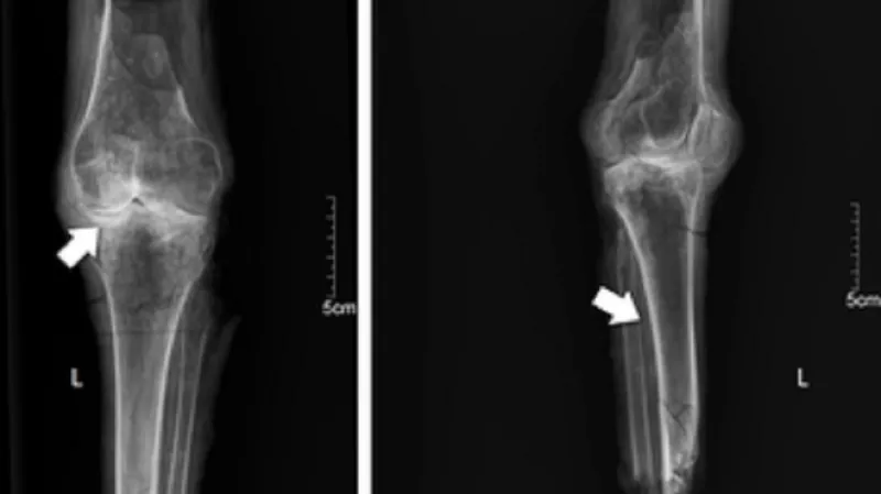 Rentgen nohou královny Nefertari