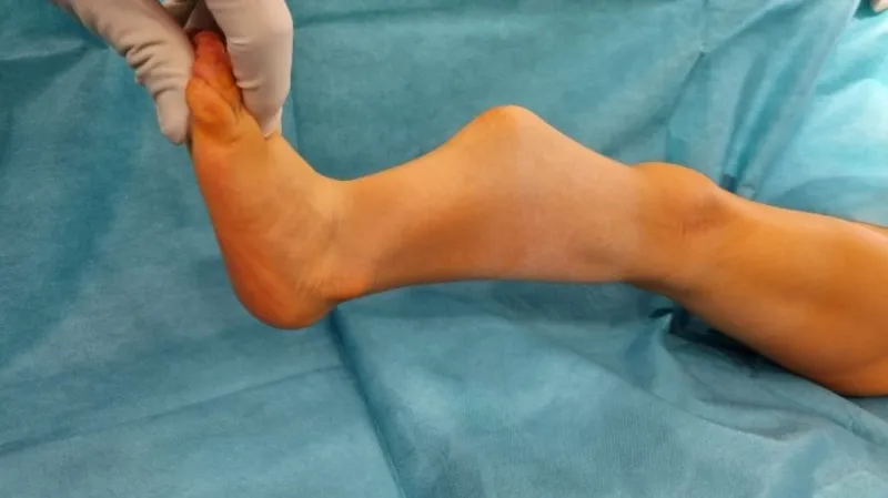 Deformovaná noha dítěte