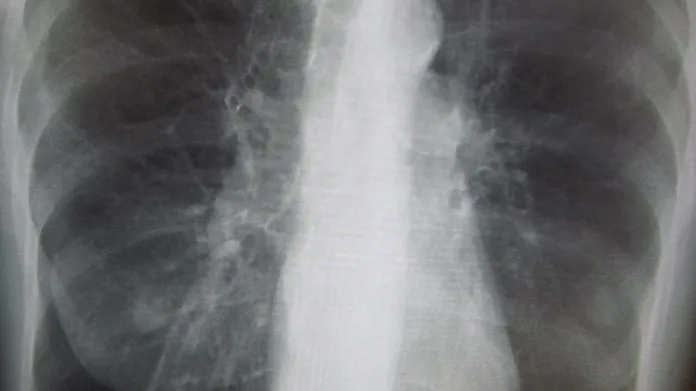 Rentgenový snímek hrudníku pacienta s CHOPN
