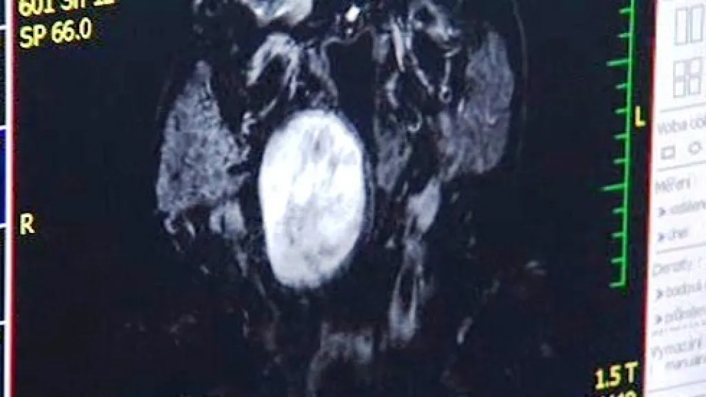 Rentgenový snímek nádoru