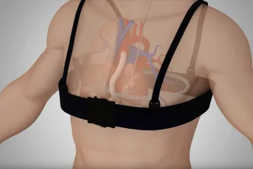 První bezdrátový pomocník srdce je na světě. Pracovali na něm i čeští lékaři