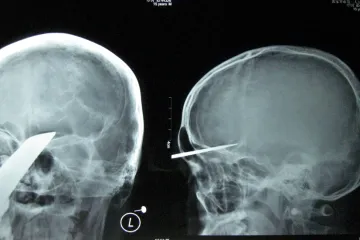 Čínskému chlapci vyoperovali z hlavy meč