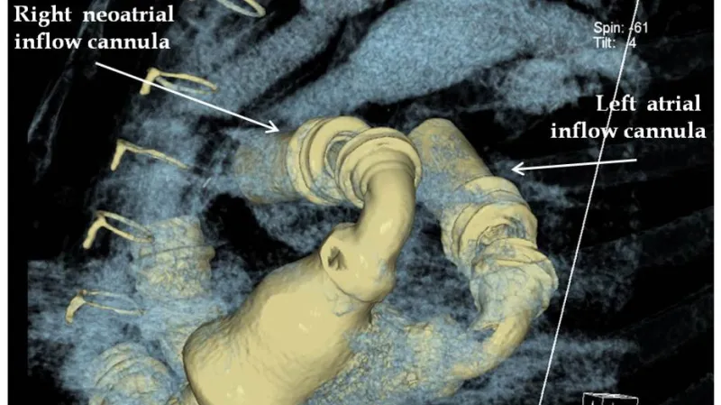 Detail pacientova srdce se dvěma čerpadly