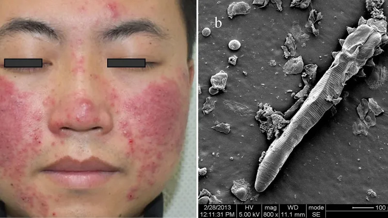 Obličej postižený vyrážkou způsobenou trudníkem