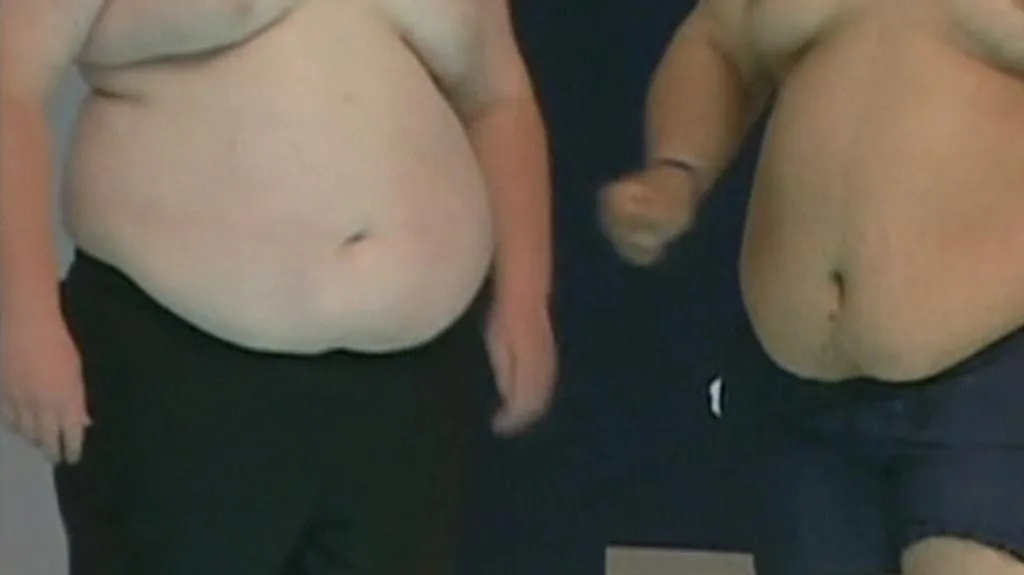 Obezita