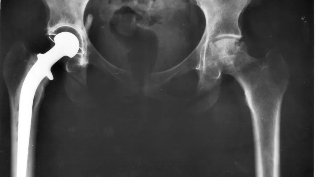 Rentgenový snímek endoprotézy