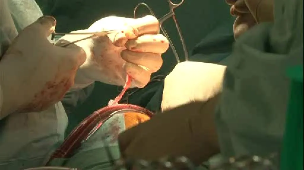 Operace v Centru kardiovaskulární a transplantační chirurgie v Brně