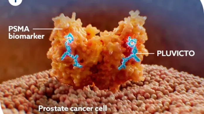 PSMA je molekula, která se vyskytuje na povrchu buňek karcinomu prostaty – dá se zobrazit pomocí zařízení PSMA. PLUVICTO dokáže na tyto nádorové buňky zacílit