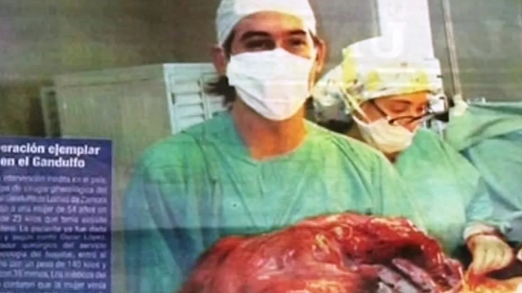Argentinský tisk o 23kilovém nádoru v těle 54leté ženy