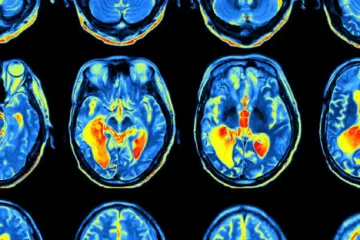 Diagnóza ADHD u dospělých zvyšuje riziko demence, zjistili vědci