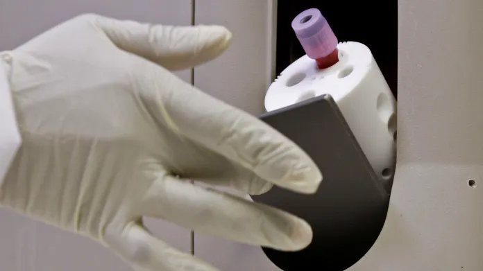 Testování krve na virus HIV
