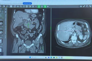 Včasný záchyt rakoviny slinivky. Praktici zapojí nové diabetiky do prevence