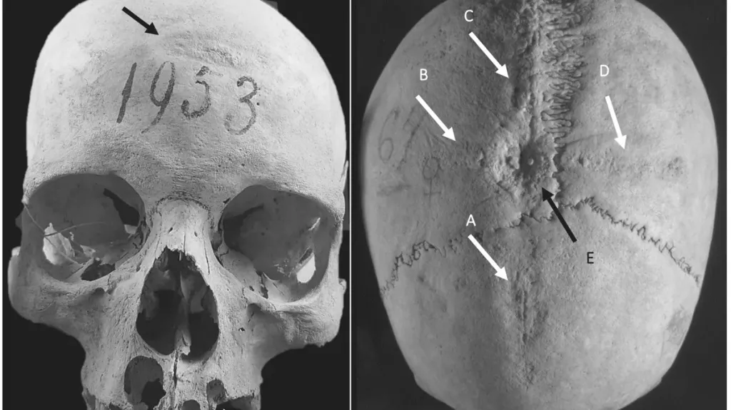 Trepanace lebky středověké ženy