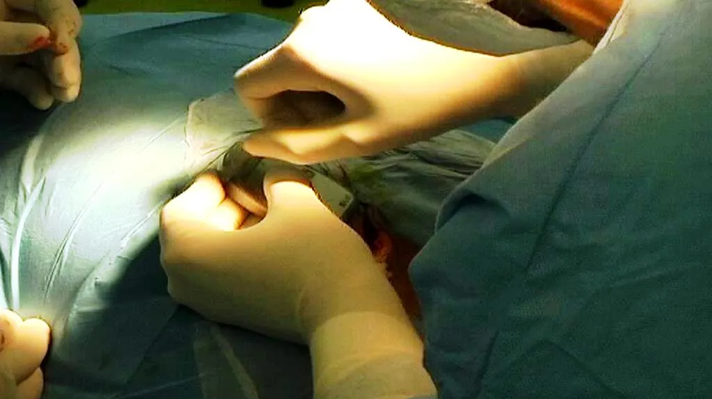 Implantace neurostimulátoru