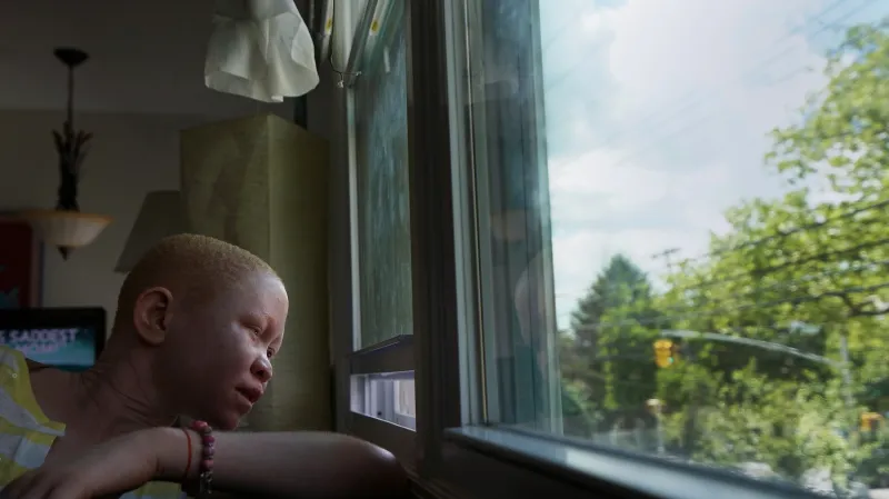 16letý Pendo Noni přišel kvůli rituálním pověrám o ruku. V New Yorku má dostat protézu