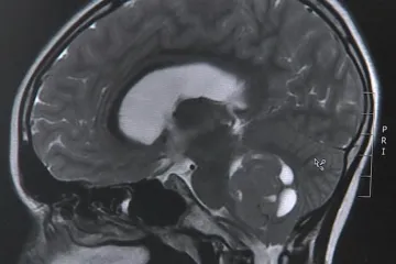 Nasazení viru ničícího nádory vzbuzuje naději u pacientů s rakovinou, píše BBC