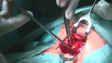 Operace páteře