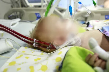 Mimotělní oběh zachránil v Česku už sto dětí