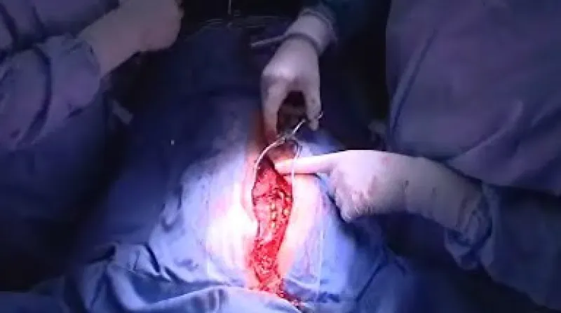 Operace skoliózy páteře, FN Brno